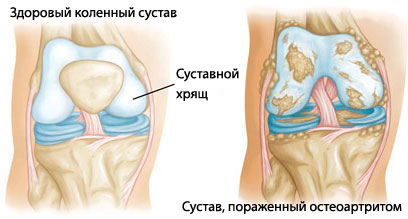 Стволовые клетки спасут нас от артрита