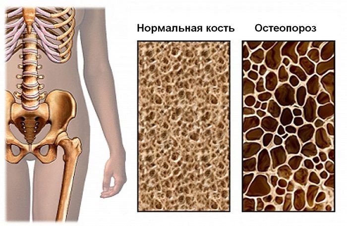 Остеопороз