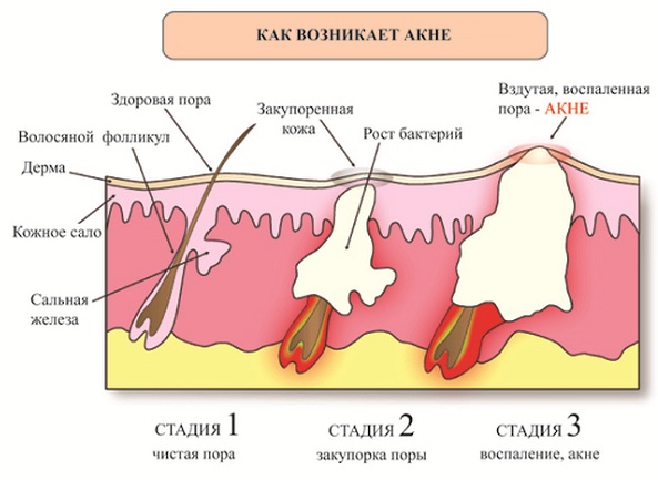 Стадии возникновения акне