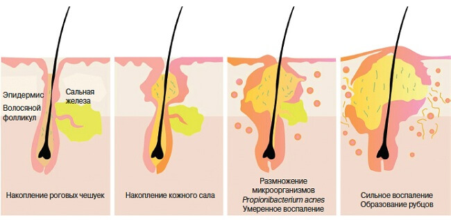 Угревая болезнь