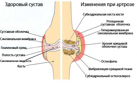 Остеоартроз