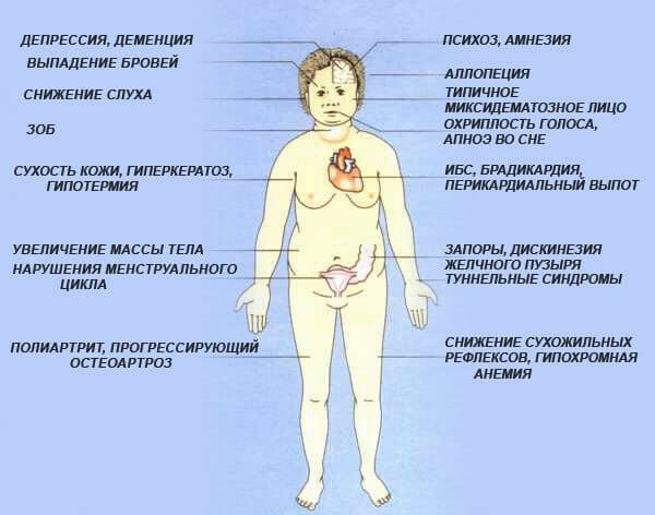 К чему приводит дефицит йода