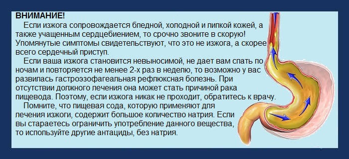 Изжога, как симптом сердечного приступа