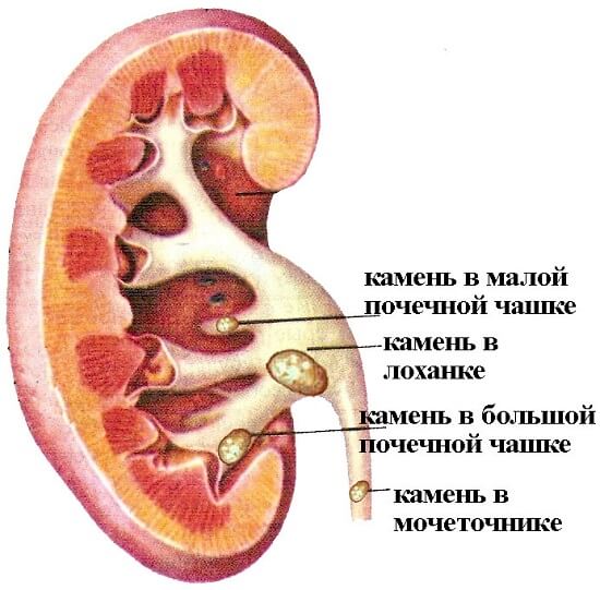 Расположение почечных камней