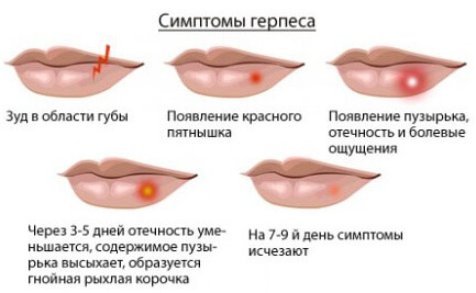 Стадии и симптомы развития герпеса