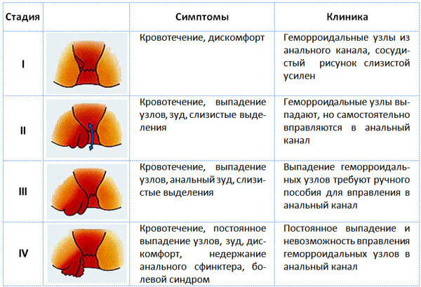 Стадии геморроя