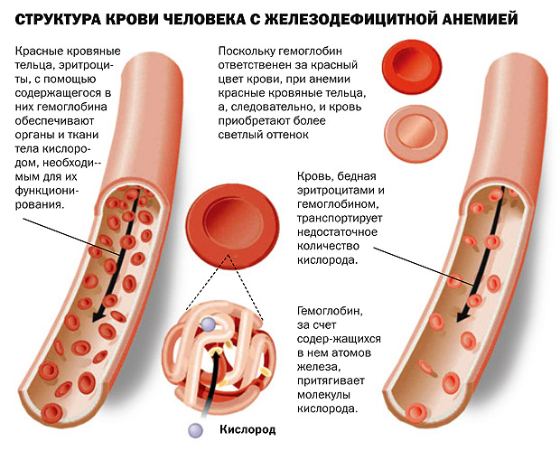 Структура крови человека с железодефицитной анемией