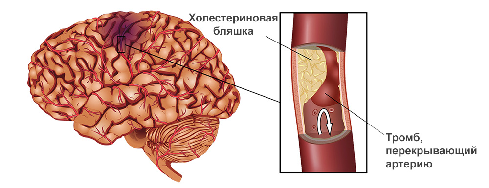 Транзиторная ишемическая атака