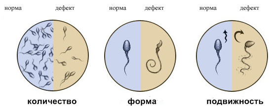 Нормы и дефекты сперматозоидов