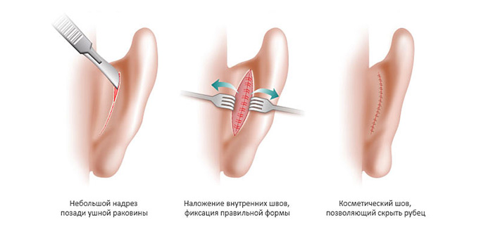 Пластика ушей