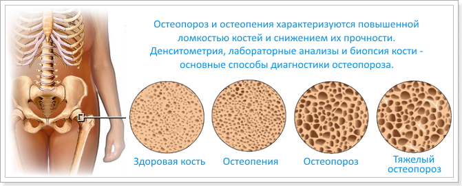 Остеопороз