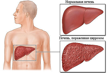 Вид здоровой и пораженной циррозом печени