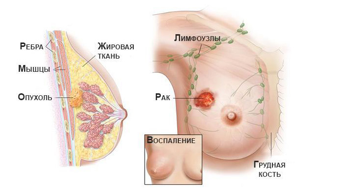 Группа риска рака груди