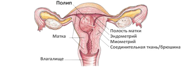 Полип эндометрия