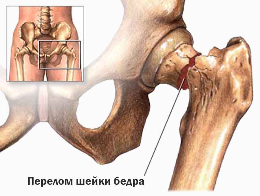 Остеопороз