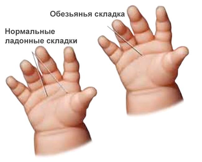 синдромом Тернера