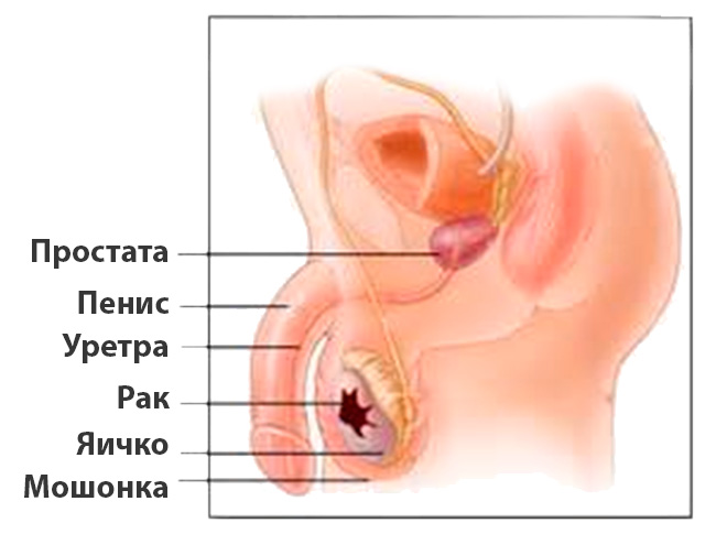 опухоли яичек