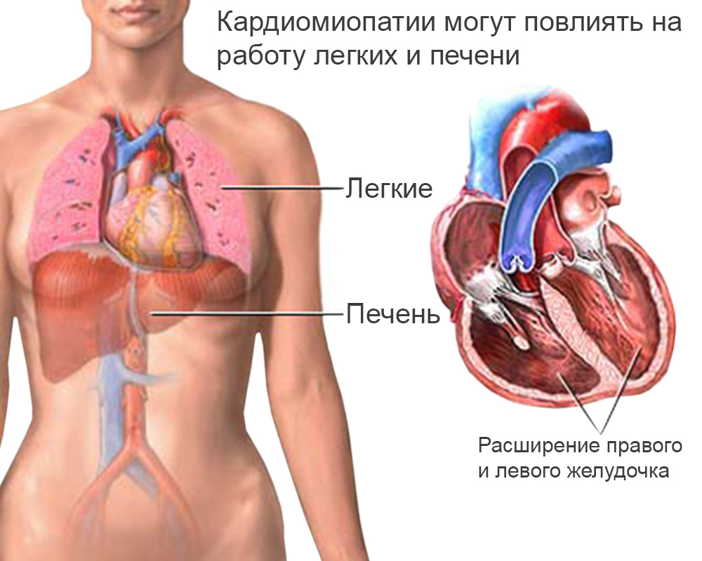 кардиомиопатии кардиомиопатии