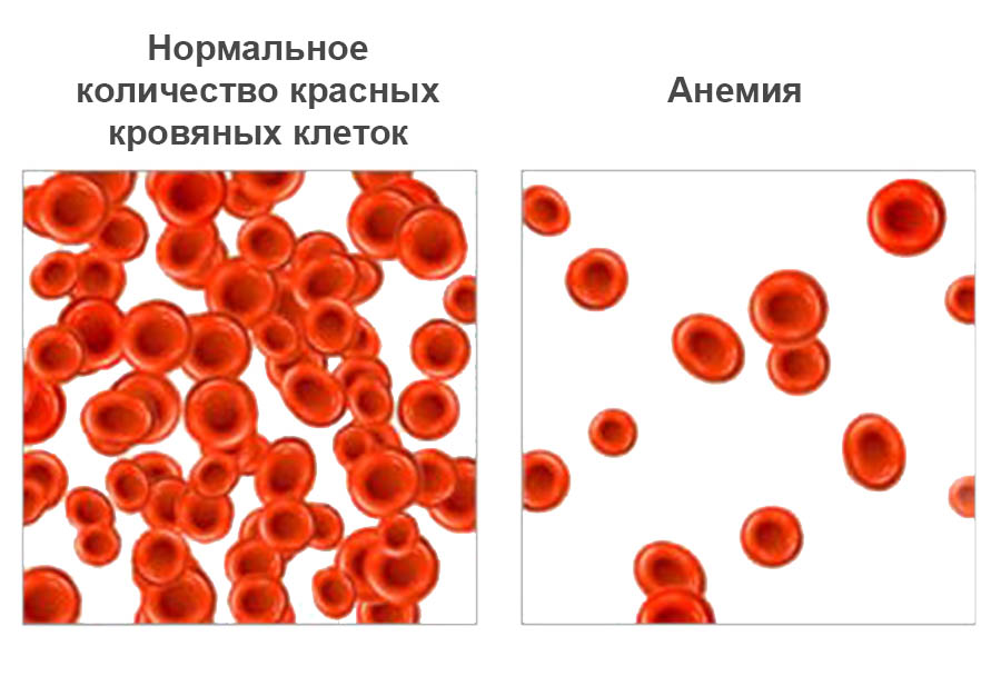 Симптом анемии