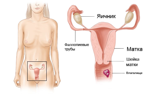 Рак влагалища