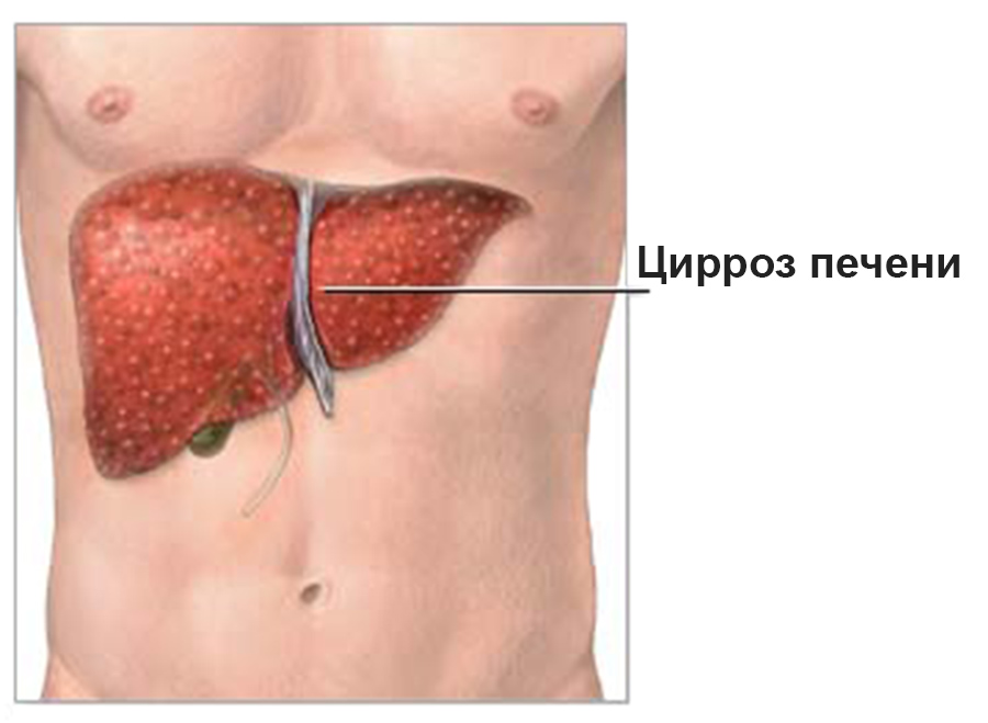 Цирроз печени