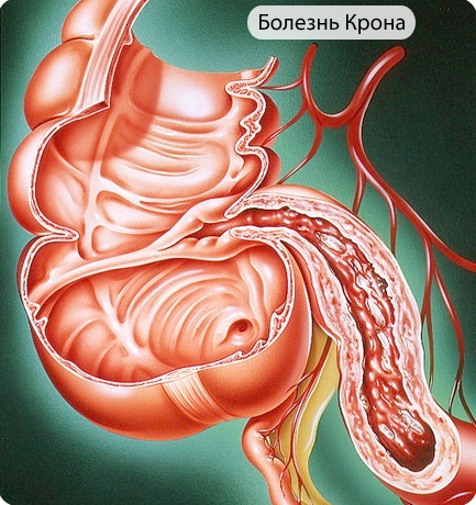 У большинства больных заболевание возникает в среднем возрасте, у женщин оно бывает в два раза чаще, чем у мужчин