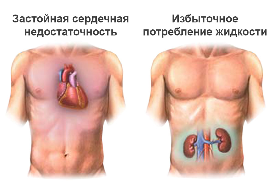 Несахарный диабет