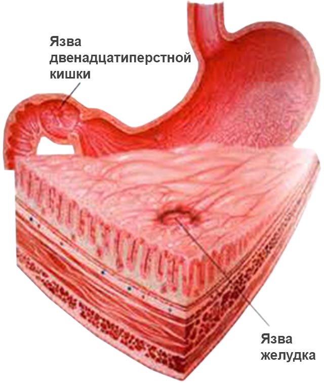 Язвы желудка и двенадцатиперстной кишки 