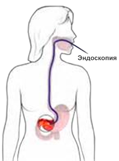 Эндоскопия