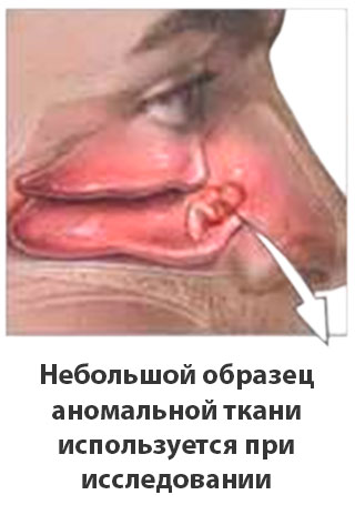 Аллергический ринит 