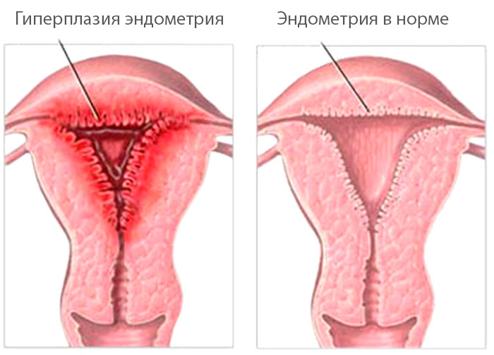 Гиперплазия эндометрия 
