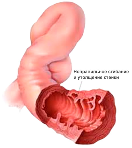 Болезнь Уиппла