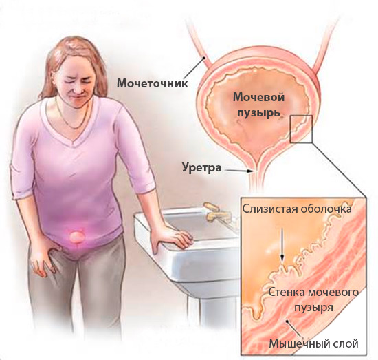Интерстициальный цистит