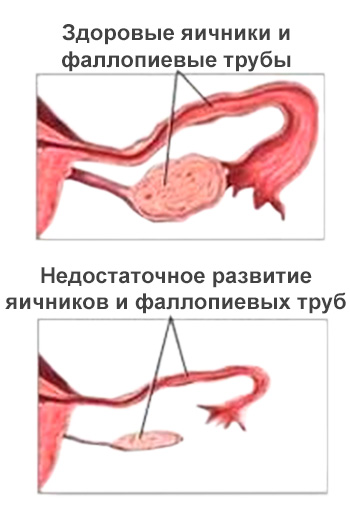гипогонадизм