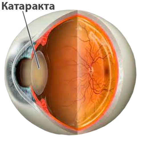 Катаракта