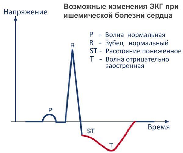 Возможные изменения ЭКГ при ишемической болезни сердца