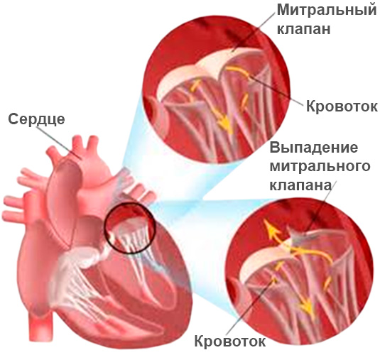 МН является следствием неправильной работы митрального клапана сердца