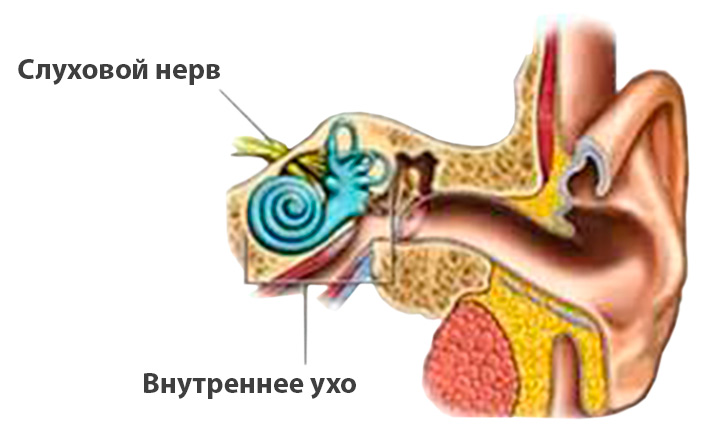 Неврит слухового нерва
