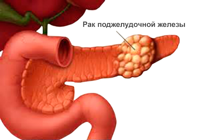 Рак поджелудочной железы 
