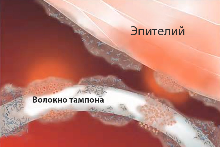 Синдром токсического шока