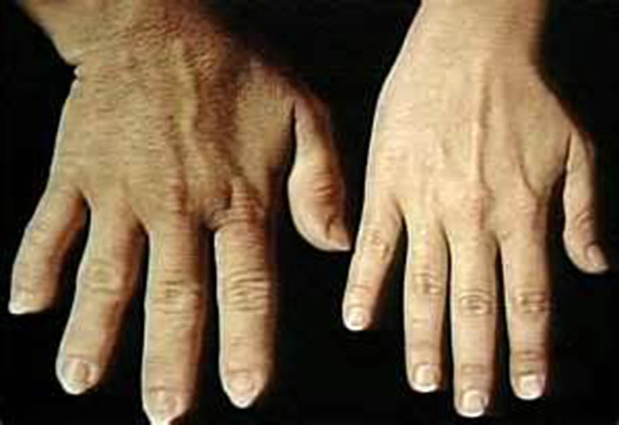 acromegaly