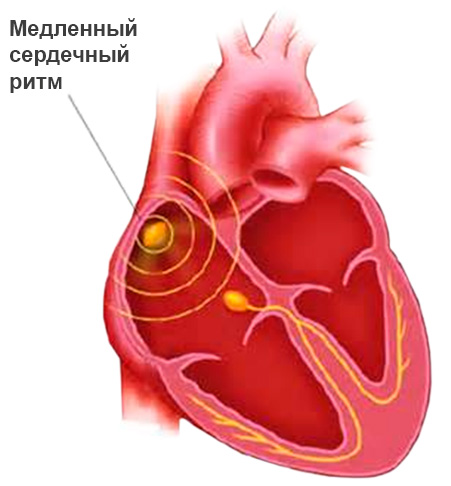 Брадикардия