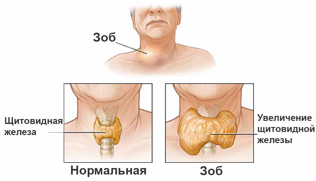 Спорадический зоб
