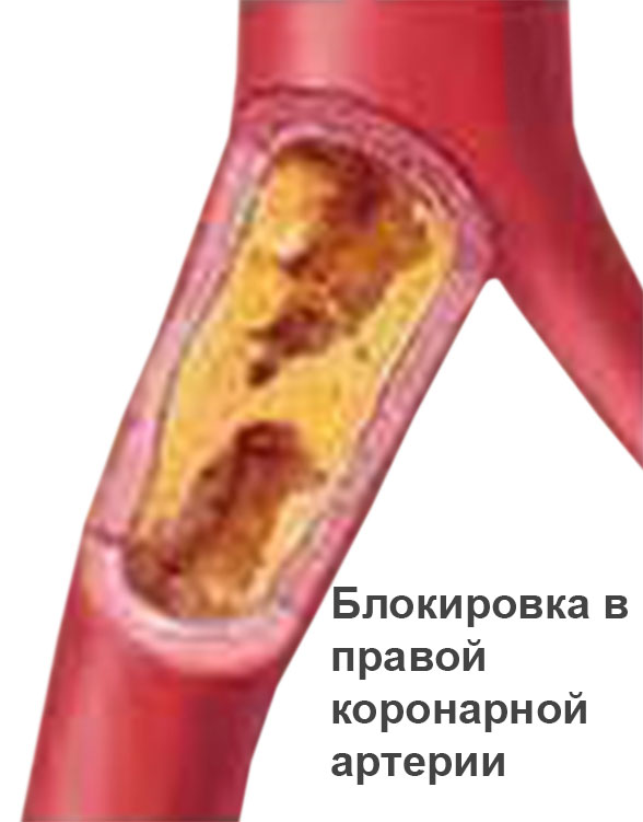 симптом легочного сердца