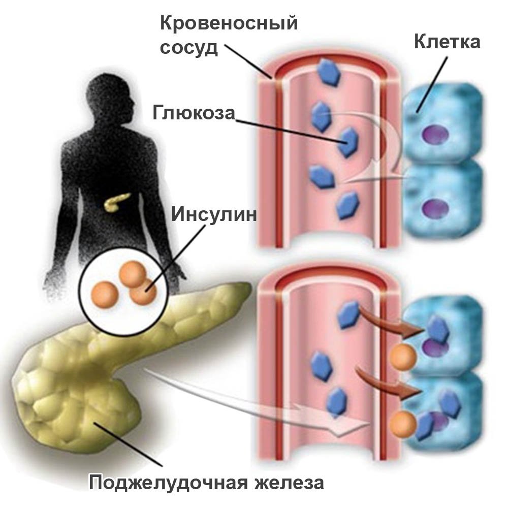 Несахарный диабет