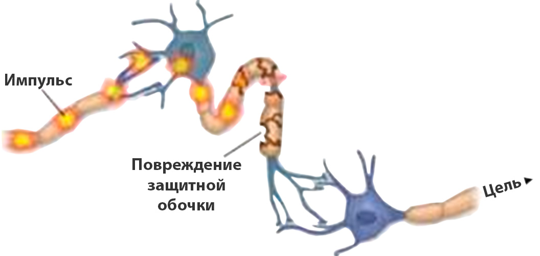 Рассеянный склероз 