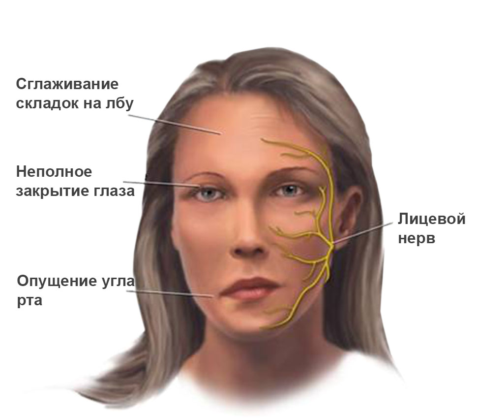 Миастения