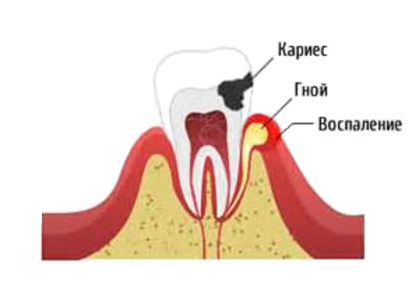 Периостит челюсти Периостит челюсти