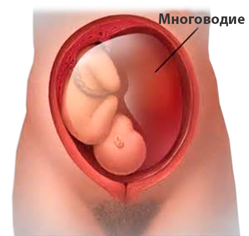 Многоводие