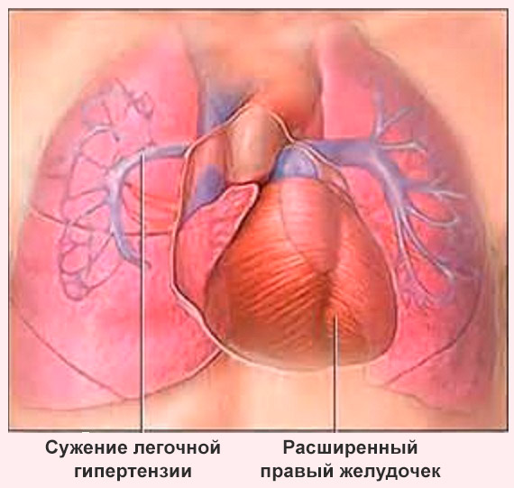 Легечная гипертензия